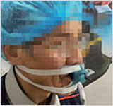 Disposable Medical Device, Endotracheal Tube