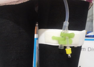 Foley Cathether, Disposable Medical Equipment